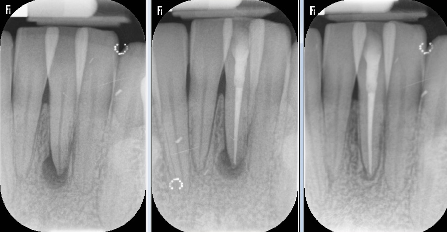 New-Road-Dental-Practice-3 Successful root canal treatment leading to healing abscess over time. Work bv Dr Dimitri Baciu