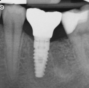 New-Road-Dental-Practice-Saffron-Walden-Implant