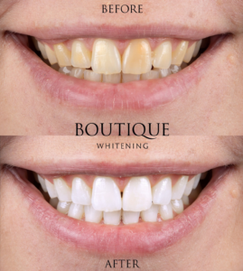 Newroaddental_Teeth_Whitening