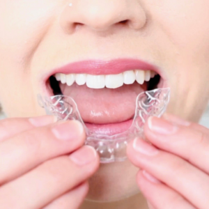 newroaddental_aligners