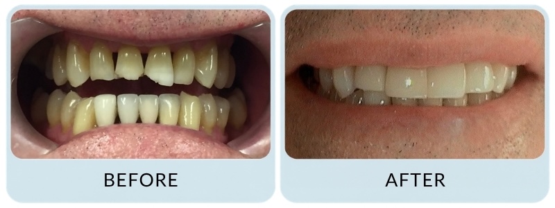 New Road Dental - Before & After Composite Bonding.jpg