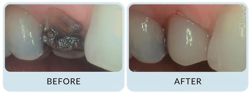 New Road Dental - Before & After Emergency.jpg