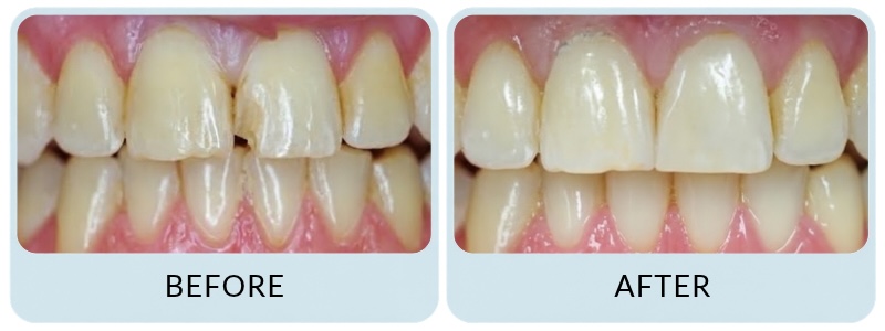 New Road Dental - Before & After broken-tooth